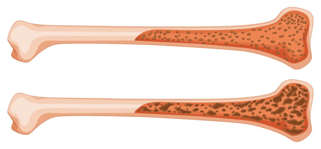 Osteoporosis in human bone